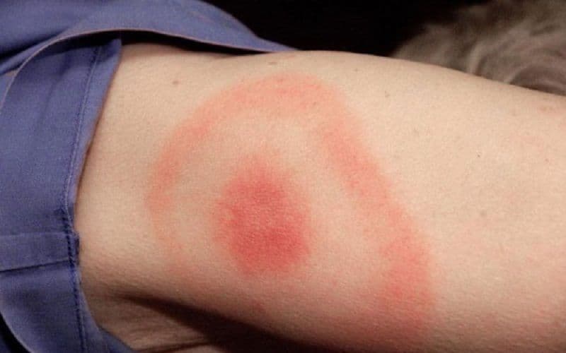 Semne de avertizare că ai boala Lyme transmisă de căpușe