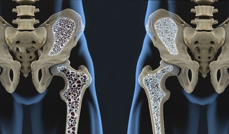 Riscul de osteoporoză și seleniul. Ce legatură există