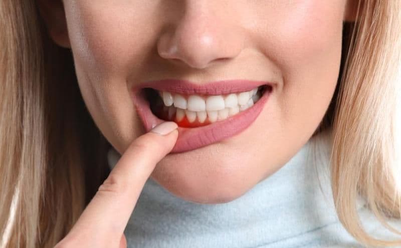 Boala gingiilor. Simptome, cauze și tratamente