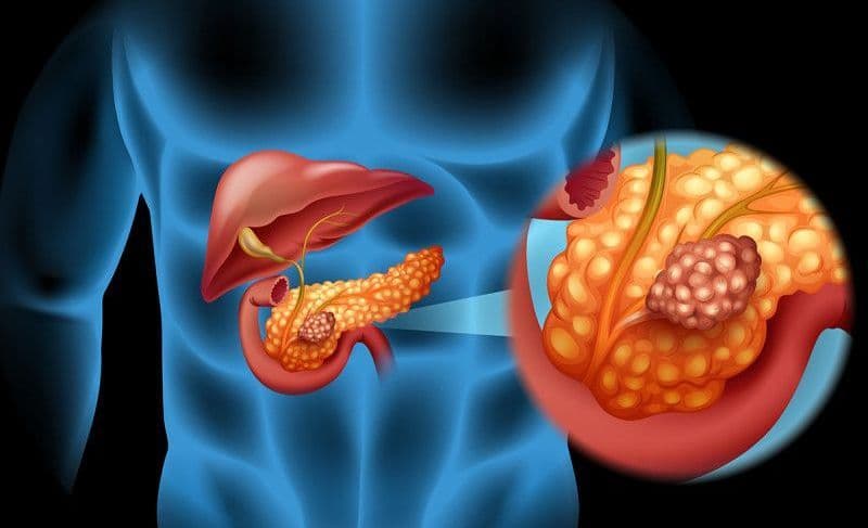 Molecula care distruge cancerul pancreatic