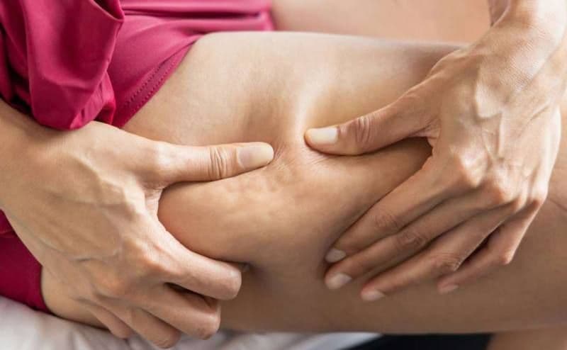 Dieta care ne poate scăpa de celulită