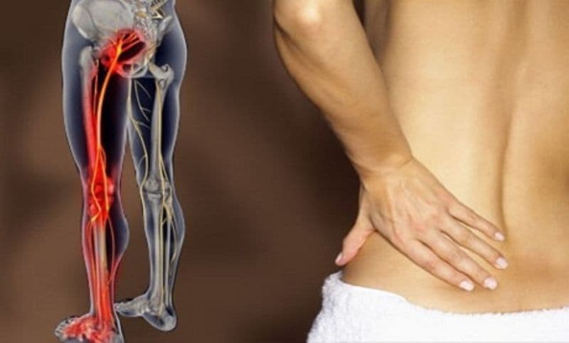 Cum să ameliorezi durerea de nerv sciatic