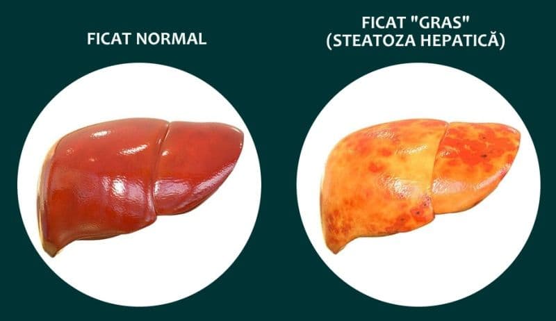 Simptome care indică boala ficatului gras