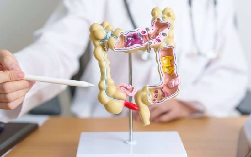 Cine are cea mai mare probabilitate de a face cancer colorectal? 