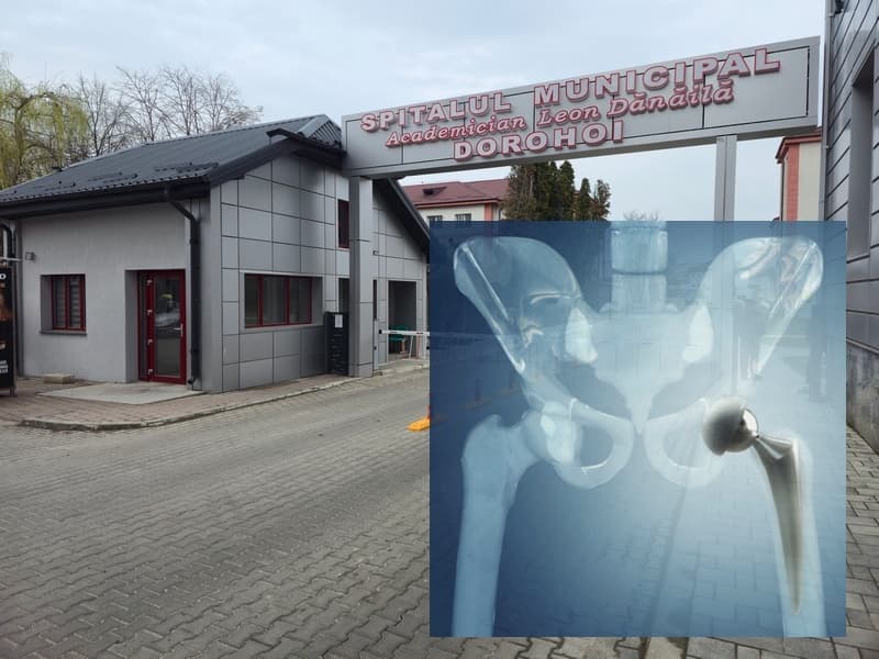 Premieră medicală la Spitalul Municipal „Academician Leon Dănăilă” Dorohoi – prima artroplastie totală de șold necimentată, realizată cu succes