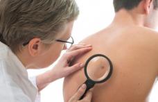 Metoda prin care poţi verifica imediat care aluniţe reprezintă un risc de cancer de piele