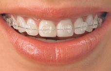 Mituri despre aparatele dentare. Cât de mult te ajută?