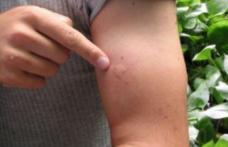Cum știi dacă ai boala Lyme după ce te mușcă o căpușă