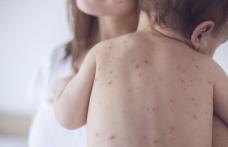 Lista județelor cele mai afectate de epidemia de rujeolă