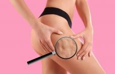 Informații importante despre lupta cu celulita, în mod natural