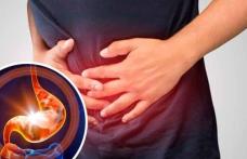 Arsuri la stomac: remedii naturale și sfaturi de prevenție