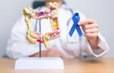 Polipii de colon, sursa de cancer. Cât de des trebuie făcută colonoscopia