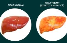 Simptome care indică boala ficatului gras