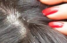 Cum scăpăm de mătreață pe cale naturală