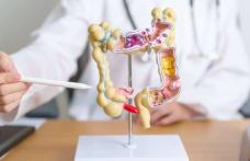 Cine are cea mai mare probabilitate de a face cancer colorectal? 