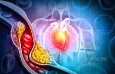 Simptome în cazul arterelor înfundate