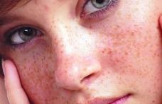 Scapă de pistrui cu cele mai bune remedii naturale!