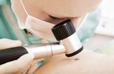 Controlul pielii, o necesitate! Cum îţi dai seama dacă o aluniţă este canceroasă sau nu