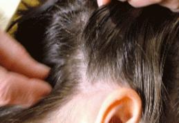 Mediul urban în topul rușinii! Adolescenți găsiți cu păduchi la început de an școlar