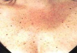 Ai observat că ai aceste pete pe piele? Ai putea avea diabet