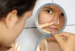 De ce nu scăpăm de acnee după adolescență