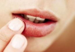 Cum să scapi de herpes simplu şi rapid