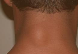 Ce este lipomul și când trebuie operat