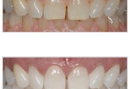 Remedii naturiste pentru albirea dintilor