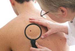 Când trebuie să ne îngrijoreze alunițele roșii