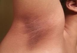 Cum scapi de pielea neagră de pe coate, genunchi sau subraț. Remedii naturiste