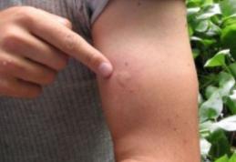 Cum știi dacă ai boala Lyme după ce te mușcă o căpușă