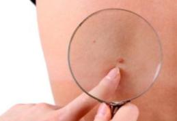 Medicii trag un semnal de alarmă: Ce sunt, de fapt, aluniţele roşii care apar pe corp