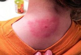 Cum se manifestă encefalita de căpușă