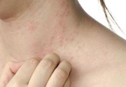 Ce se întâmplă în organism când stai mult la soare