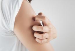 Remediu naturist care tratează iritațiile și eczemele