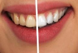 Patru modalități naturale pentru albirea dinților