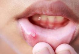Afta bucală, mai periculoasă decât credem! De ce apare şi ce boli foarte grave poate ascunde