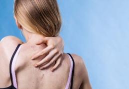 Remediu natural pentru coșurile de pe spate