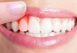 Remedii naturiste pentru sângerările gingivale