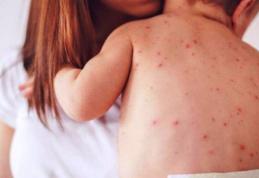 Numărul cazurilor de rujeolă a ajuns la 20.000 în România! Copiii sunt cei mai vizaţi