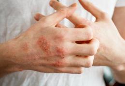 O boală de piele extrem de dureroasă este agravată de stres
