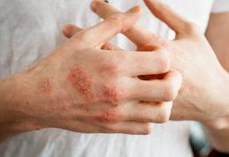 O boală de piele extrem de dureroasă este agravată de stres
