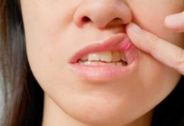 Aftele bucale: de ce apar și cum poți scăpa de ele prin metode naturiste