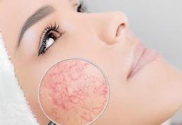 Cum se manifestă și ce este Rozaceea