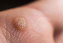 Cum puteți elimina un neg fără durere