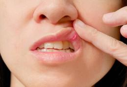 Remedii naturale pentru stomatite