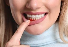 Cum se previne parodontoza în mod natural