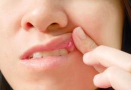 Când apar aftele bucale