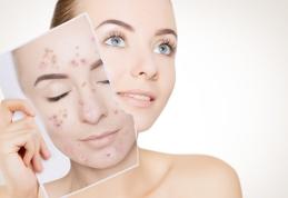 Acneea – Soluții naturale pentru a scăpa de ea