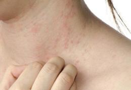 Cum recunoaștem și cum tratăm alergia la căldură